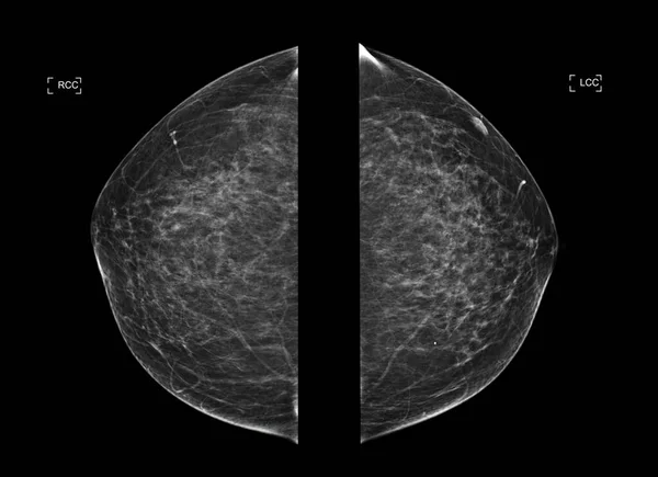 Rtg Mammografia Cyfrowa Lub Mammografia Obu Stronach Piersi Widok Diagnonsis — Zdjęcie stockowe