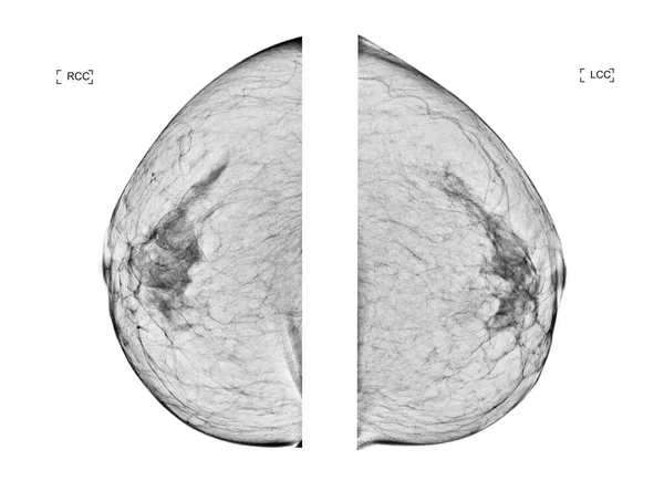디지털 Ray Digital Mammogram Mammmography 배경에 고립된 여성들에게 유방암의 대각선 — 스톡 사진