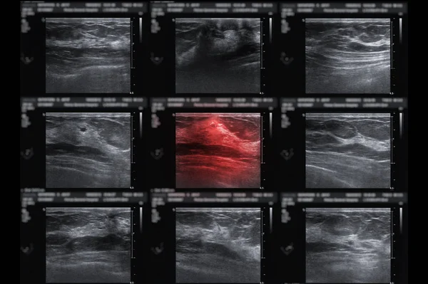 ultrasound of breast  after mammography  for diagnonsis Breast cancer in women isolated on black background.
