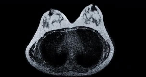 Mri Piersi Lub Rezonans Magnetyczny Piersi Kobiet Badań Przesiewowych Raka — Wideo stockowe