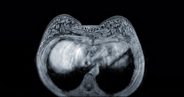 Breast Mri Magnetic Resonance Imaging Breast Women Screening Breast Cancer — Stock Video