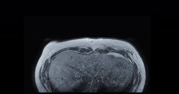 Pencitraan Mri Payudara Atau Resonansi Magnetik Payudara Pada Perempuan Untuk — Stok Video