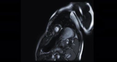 MRI heart or Cardiac MRI ( magnetic resonance imaging  of heart ) showing heart beating for diagnostic heart disease.