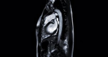 MRI heart or Cardiac MRI ( magnetic resonance imaging  of heart ) showing heart beating for diagnostic heart disease.