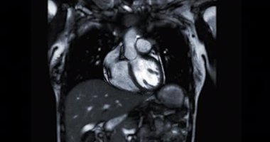 MRI heart or Cardiac MRI ( magnetic resonance imaging  of heart ) showing heart beating for diagnostic heart disease.
