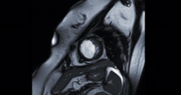 Mri Heart Cardiac Mri Magnetic Resonance Imaging Heart Showing Heart — Stockvideo