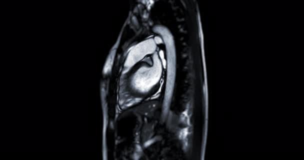Mri Heart Cardiac Mri Magnetic Resonance Imaging Heart Showing Heart — Stok video