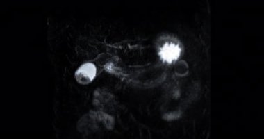 MRCP or Magnetic resonance cholangiopancreatography Coronal MIP  showing visualize the biliary system and pancreatic ducts .