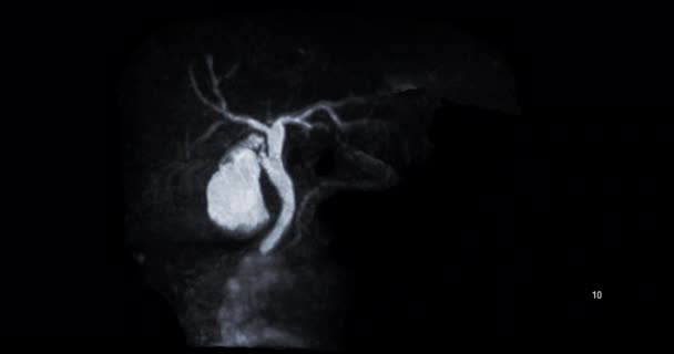 磁共振胆管造影 Mrcp 或磁共振胆管造影术显示胆道系统和胰管可视化的冠状Mip — 图库视频影像