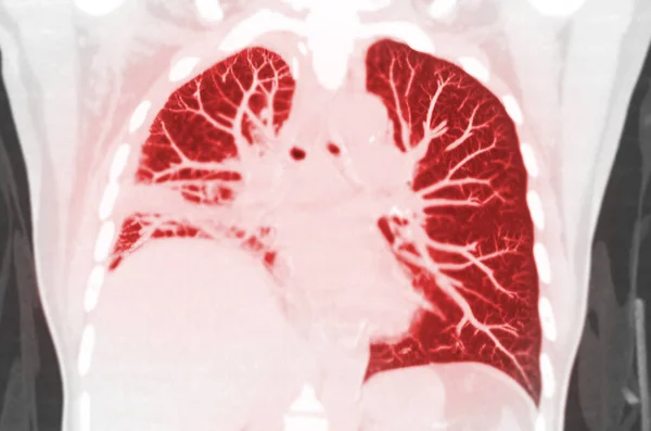 Tomografía Computarizada Del Tórax Mip Coronal Pulmonar Vista Infección Pulmonar — Foto de Stock