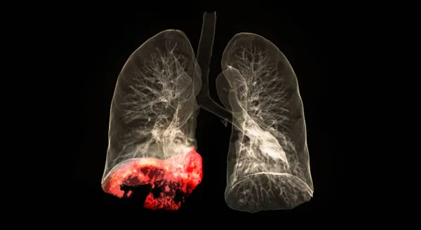 Mellkasi Vagy Tüdő Renderelés Kép Mutatja Tüdő Fertőzés Covid Jobb — Stock Fotó