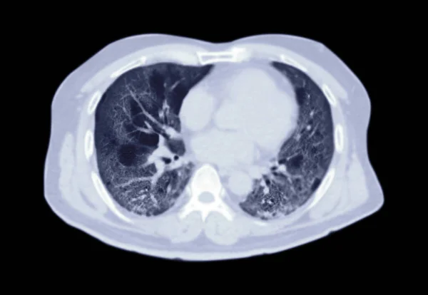 Scan Der Brust Oder Lunge Axiale Ansicht Der Lungeninfektion Covid — Stockfoto