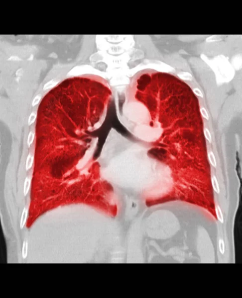 肺感染症の胸部または肺冠動脈ビューのCtスキャン黒の背景に隔離されたガラス不透明度を有するCovid — ストック写真
