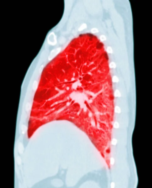 Tomografia Computadorizada Tórax Pulmão Visão Sagital Infecção Pulmonar Covid Com — Fotografia de Stock