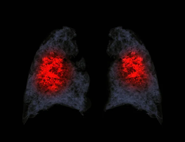 Tórax Renderização Mostrando Infecção Pulmonar Covid — Fotografia de Stock