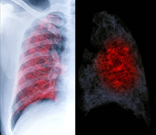 Συγκρίνετε Ακτινογραφία Θώρακος Και Αξονική Τομογραφία Απόδοση Στήθους Που Δείχνει — Φωτογραφία Αρχείου