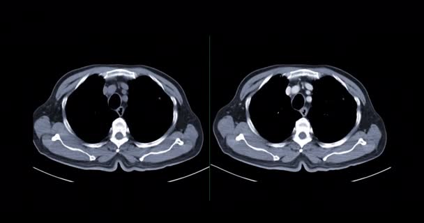Ct胸部或Ct肺轴视软组织和肺窗口诊断肺部疾病和Covid — 图库视频影像
