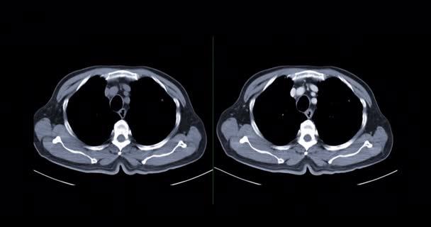 Tórax Visão Axial Pulmonar Tecido Mole Janela Pulmonar Para Doenças — Vídeo de Stock