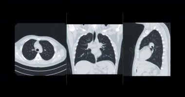 CT Chest or CT Lung axial view soft tissue and lung window for diagnostic lung diseases and covid-19.