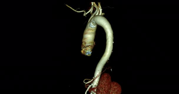 Cta Whole Aorta Screen Diagnosis Aortic Aneurysm — Stok video