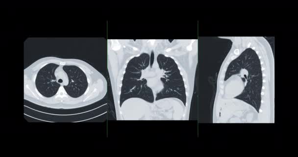 Tórax Pulmón Axial Ver Tejido Blando Ventana Pulmonar Para Diagnóstico — Vídeos de Stock