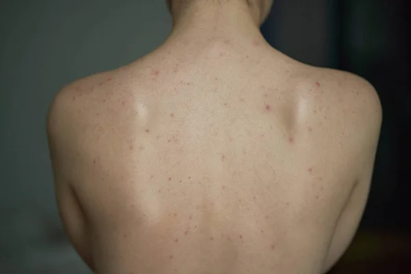 Feminino Volta Com Acne Problemas Cuidados Pele Rapariga Com Alergia — Fotografia de Stock