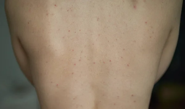 Feminino Volta Com Acne Problemas Cuidados Pele Rapariga Com Alergia — Fotografia de Stock