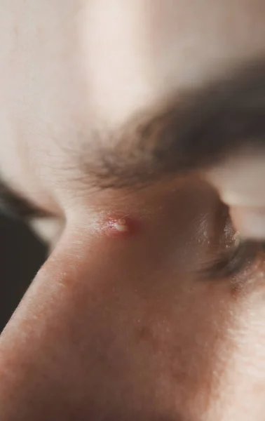 Macro Photos White Red Ripe Pimple Face Man Eye Nose — Stock Photo, Image