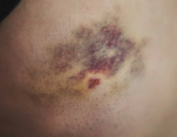 Verschlimmerung Der Durch Einen Unfall Verletzten Haut — Stockfoto
