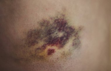 Kazadan sonra ciltte travma. Haematom iyileşme süreci. Bacağa çarptıktan sonra iç kanama.