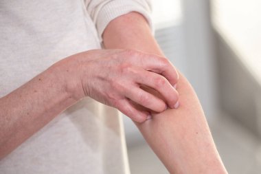 Kaşınan ve kolunu kaşıyan bir kadın. Alerji belirtileri.