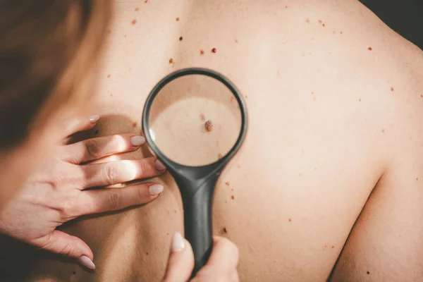Dermatolog Vyšetřující Kůži Zádech Pacienta — Stock fotografie