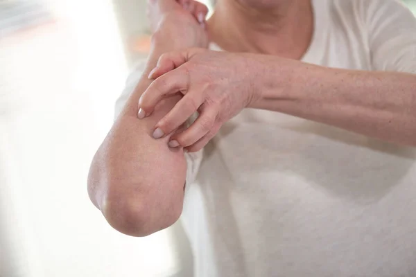 彼女の腕をかゆみ 引っ掻いている女性 アレルギー症状 — ストック写真
