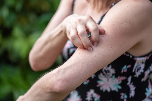 Vrouw Met Jeuk Krassen Haar Arm — Stockfoto