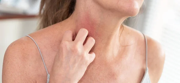 Een Vrouw Met Jeuk Krassen Haar Nek Allergische Symptomen — Stockfoto