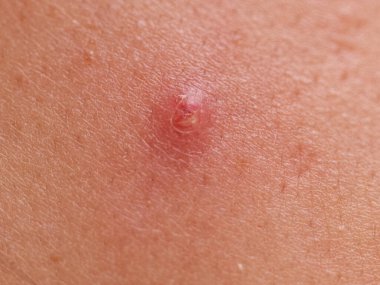 Genç bir kadının yüzündeki sivilce yakın plan. Kadın yüzünde sorunlu ten kavramı.