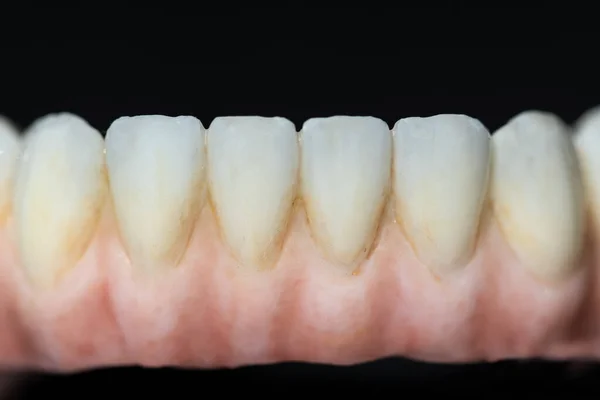 Opieka Dentystyczna Zamknij Ceramiczny Cyrkon Proteza Stomatologiczna Implantów Tlenku Cyrkonu — Zdjęcie stockowe