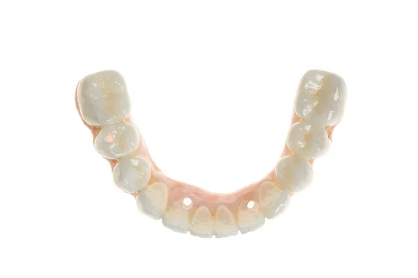 Tandvård Keramiskt Zirkonium Slutlig Version Ovanifrån Närbild Tandprotes Zirkoniumoxid Implantat — Stockfoto