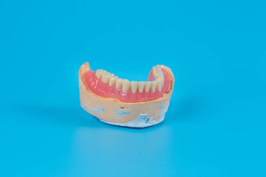 Mavi arka planda diş eti ve diş eti olan çenenin alçı modeli. Yapay çene, dişçiler ve hastalar için görsel yardım.