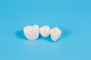 Plastik diş kaplaması, diş köprüsünün sahte protezi mavi arka planda üç diş için. Diş hekimleri ve hastalar için görsel yardım..
