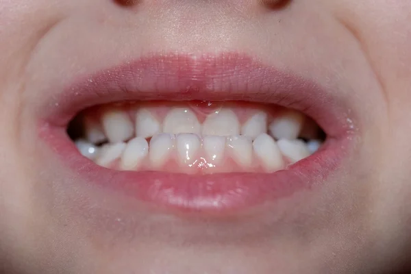 Bir çocuğun malocclusion 'ı, bir çocuğun ön dişlerine yakın çekim.