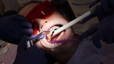 Diş hekimliği, diş teli yerleştirme, kurulumdan önce dişlerdeki jöleyi yıkama.