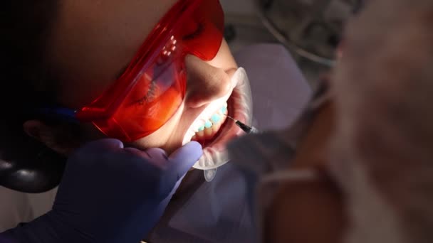 Стоматология, установка брекетов, травление зубов гелем — стоковое видео