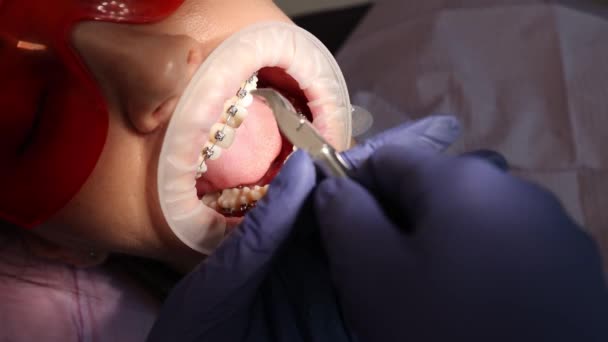 Fixing of the Damon Q bracket system, Dentistry, orthodontics — Stock Video