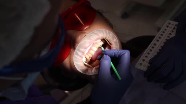 Стоматология, ортодонтия, установка брекетов, нанесение геля на зубы — стоковое видео