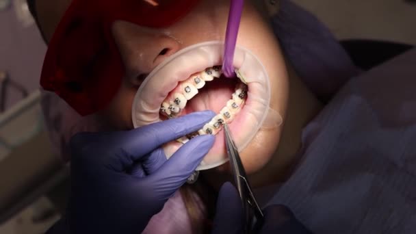 Ένας ορθοδοντικός, που φοράει ιατρικά γάντια, δουλεύει με μια ασθενή στο οδοντιατρικό γραφείο. Εγκατάσταση τιράντες και ευθυγράμμιση δοντιών. Οδοντιατρική θεραπεία. — Αρχείο Βίντεο
