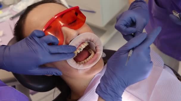 Dentistas nomeação nstallation de retentores, aparelhos nos dentes e alongamento do arco para fixação. — Vídeo de Stock