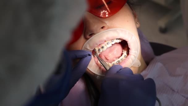 Zubní lékařství, podvádění rovnátka, ortodoncie, proces upevňování — Stock video
