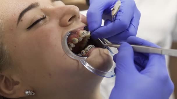 La instalación y la fijación del dardo para los aparatos ortopédicos a los dientes de la mujer joven — Vídeos de Stock