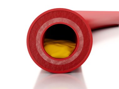 3d Cholesterol plaque in artery. clipart